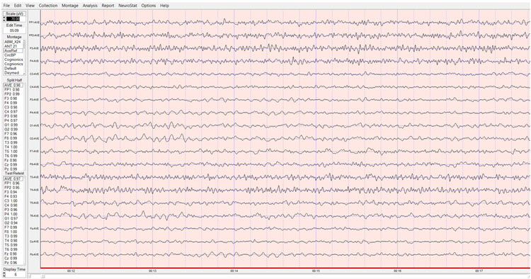 Average reference montage eyes-open pre-training baseline
